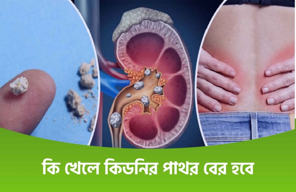 কিডনিতে পাথর হলে করণীয় কি