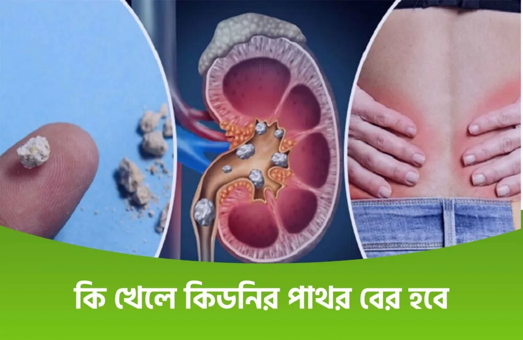 কিডনিতে পাথর হলে করণীয় কি