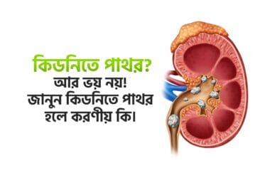 কিডনিতে পাথর হলে করণীয় কি