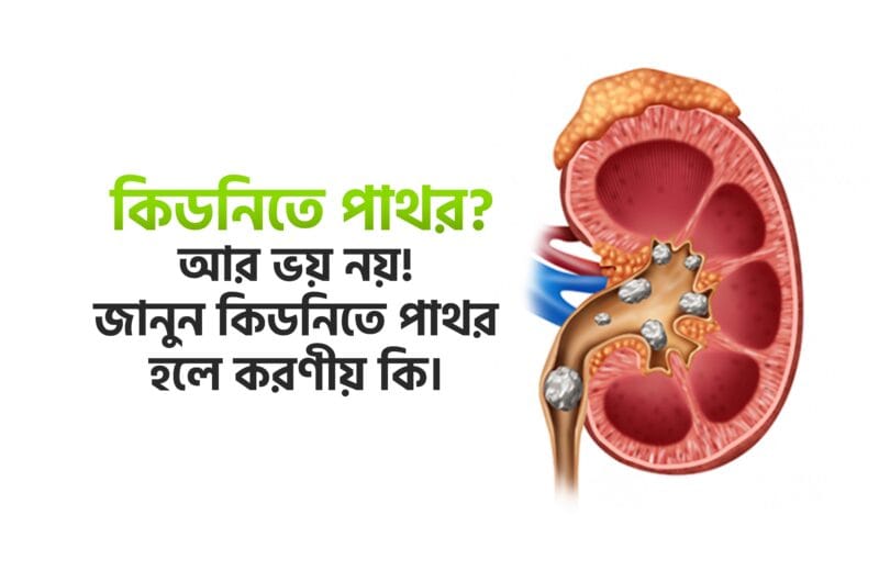 কিডনিতে পাথর হলে করণীয় কি