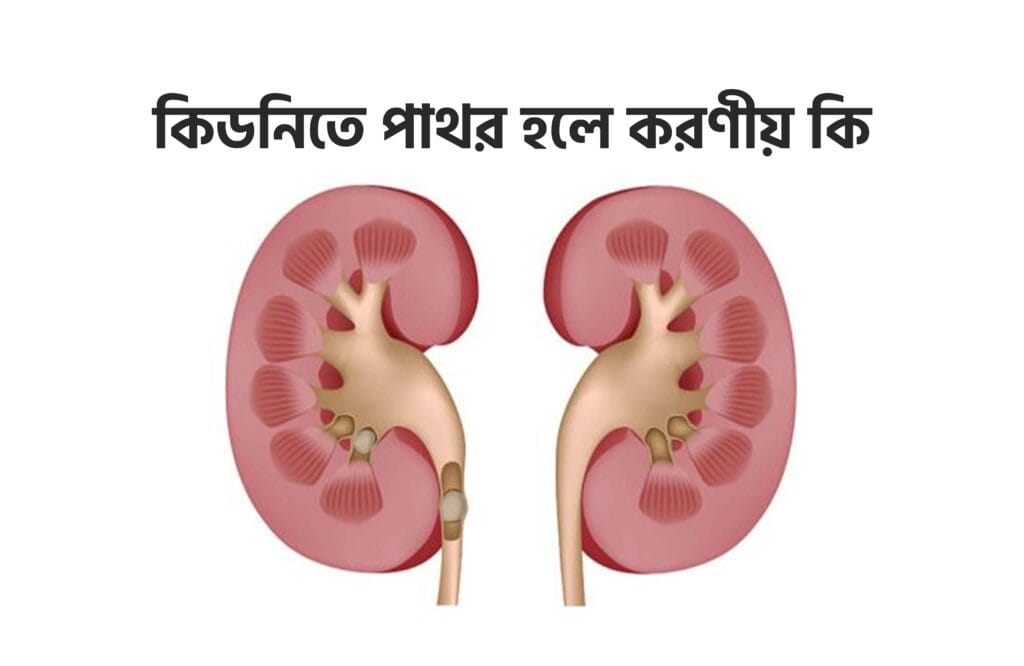 কিডনিতে পাথর হলে করণীয় কি