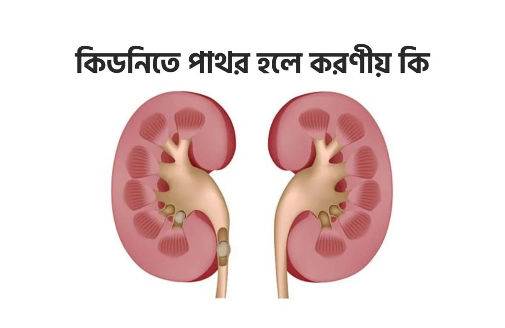 কিডনিতে পাথর হলে করণীয় কি
